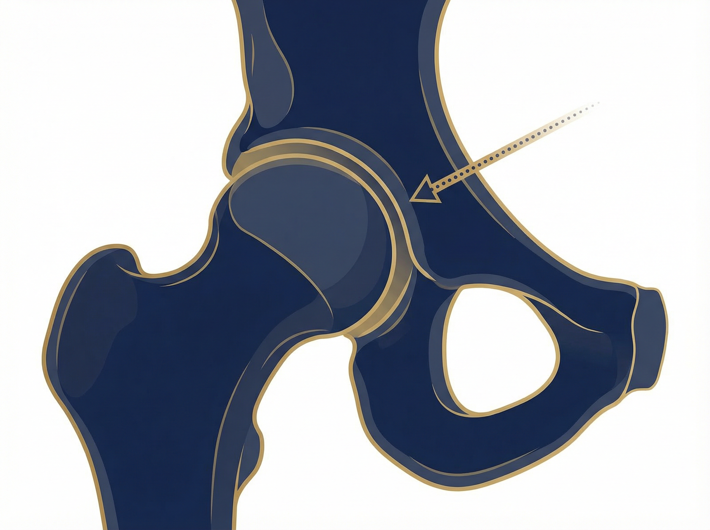 Minimally invasive anterior approach hip surgery